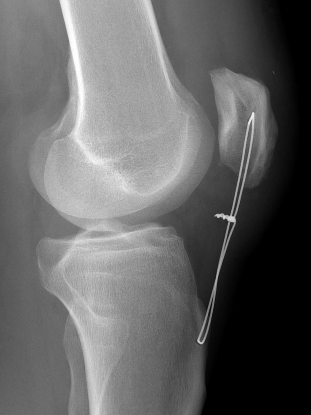 Patella Box Wire Lateral